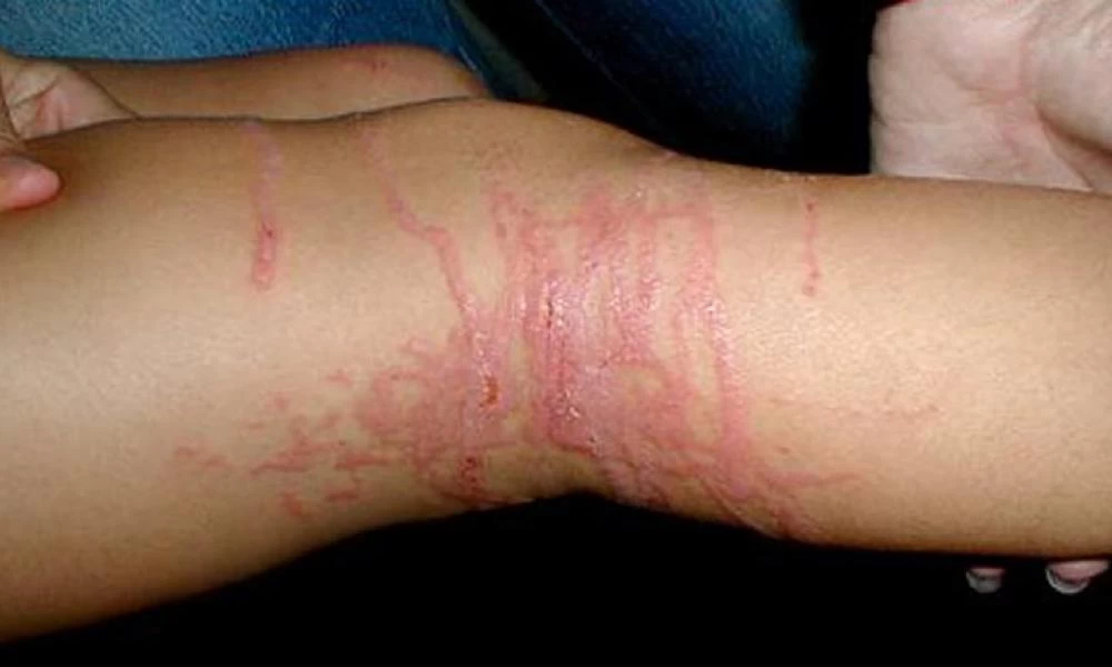 Τραγωδία με τον θάνατο ανηλίκου ύστερα από τσίμπημα τσούχτρας